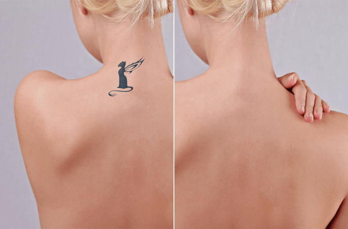 Laser Tattoo Removal: Top Three Things