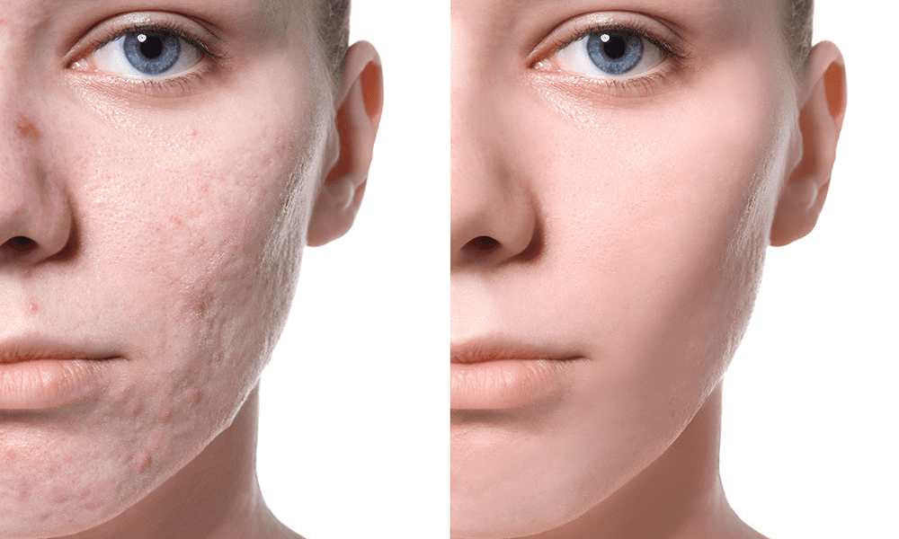 Karriere partner Skærm Laser Acne Scar Removal: Does It Work? | Metro Dermatology
