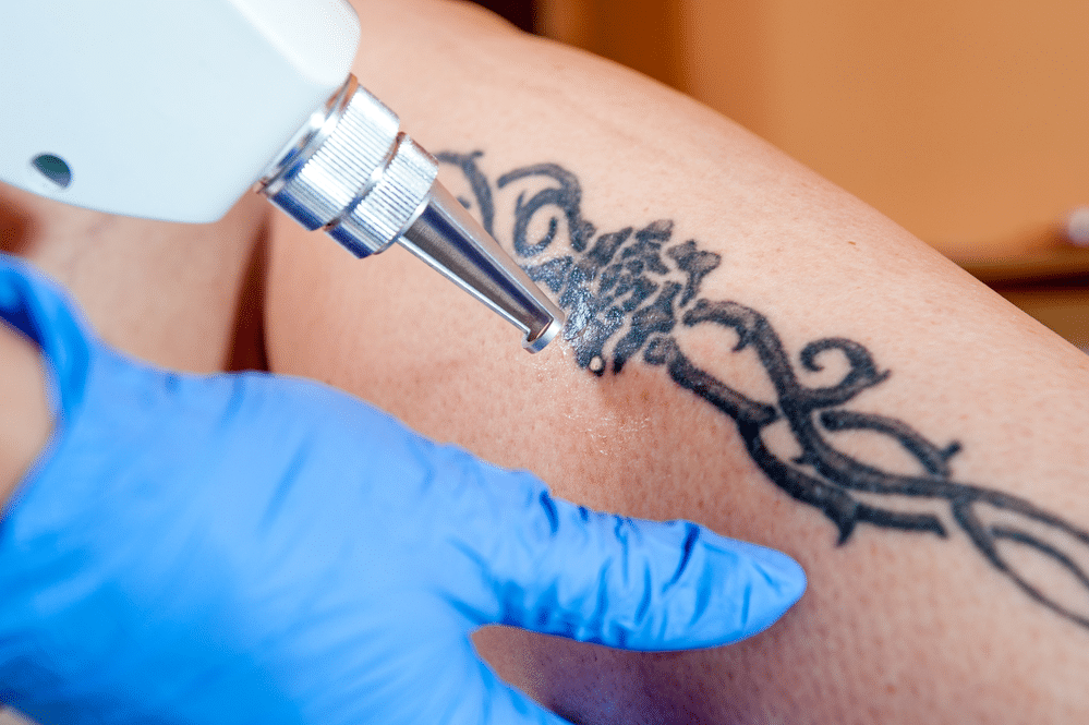 Can Lasers Remove Tattoos Completely?
