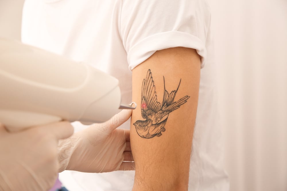 Laser Tattoo Removal in Queens, NY | Metro Dermatology