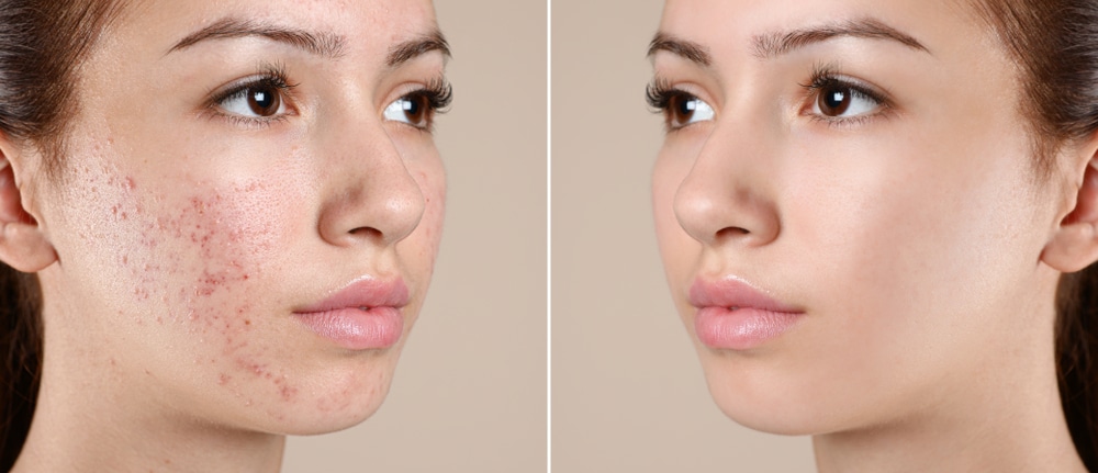 A Comprehensive Guide to Banishing Acne Scars