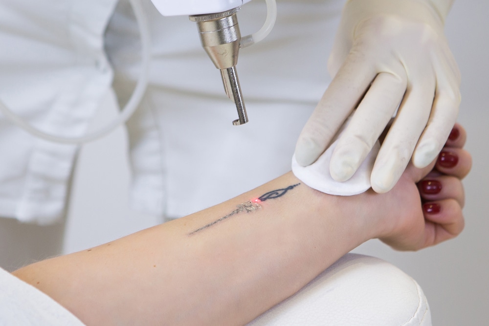 Dermatology's Laser Tattoo Removal